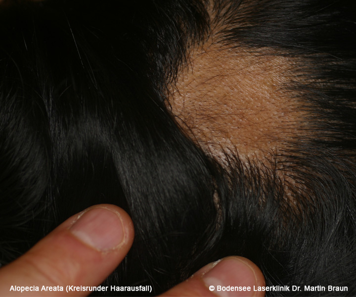 Kreisrunder Haarausfall